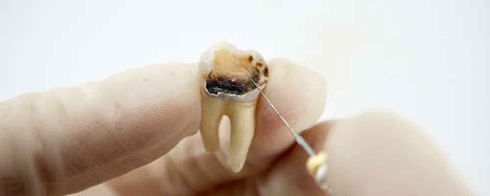 虫歯が進行して抜いた歯の断面と歯科用の器具｜マルイ錦糸町シティデンタルクリニック