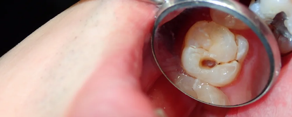 奥歯の噛む面に見える茶色い点を口腔内ミラーで確認しているところ｜マルイ錦糸町シティデンタルクリニック