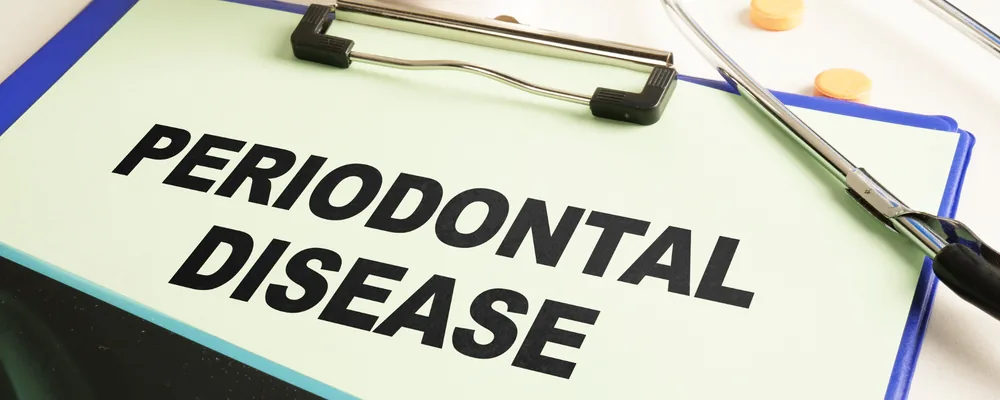 PERIODONTAL DISEASEと書かれた診察用のクリップボード｜マルイ錦糸町シティデンタルクリニック
